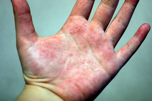 2344262526_60911c76dd 2344262526 60911c76dd Natural Treatment for Eczema