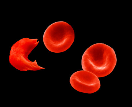 Anemia Anemia What Causes Anemia?