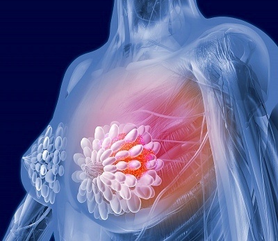 Breast-Cancer Breast Cancer Causes of Breast Cancer