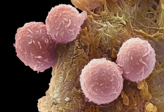 Leukemia Leukemia1 550x375 What Causes Leukemia?