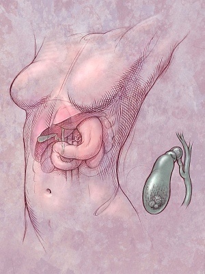gallstones gallstones What Causes Gallstones?