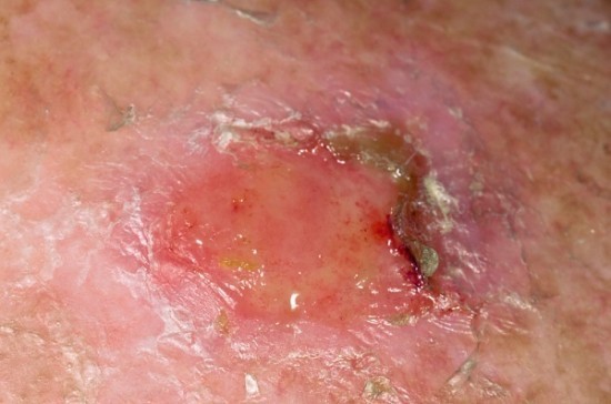 skin-cancer skin cancer 550x364 What Causes Skin Cancer?