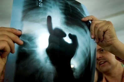 What Causes Tuberculosis? tuberculosis What Causes Tuberculosis?