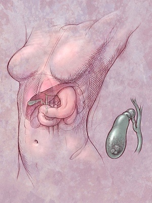 what-causes-gall-stones what causes gall stones What Causes Gall Stones?
