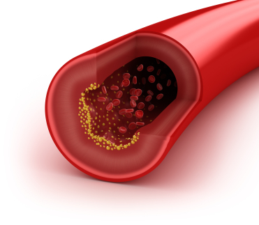 what-causes-high-cholesterol what causes high cholesterol What Causes High Cholesterol?