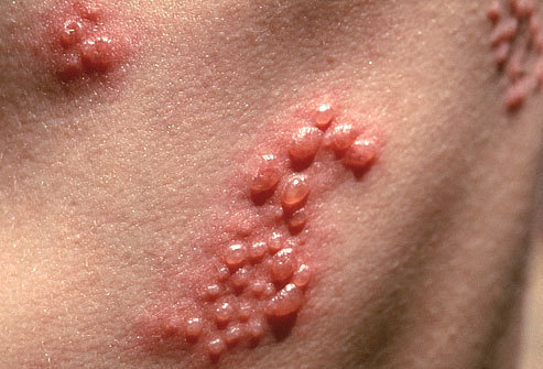 what-causes-shingles what causes shingles What Causes Shingles?