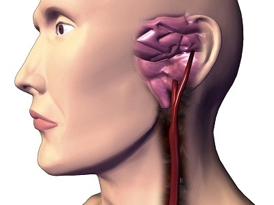 what-causes-stroke what causes stroke What Causes Stroke?