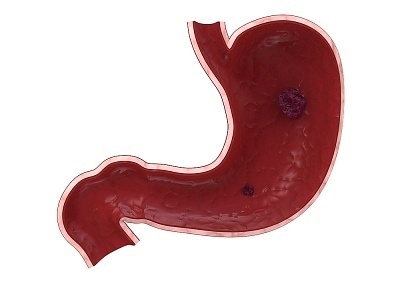 what-causes-ulcers what causes ulcers What Causes Ulcers?