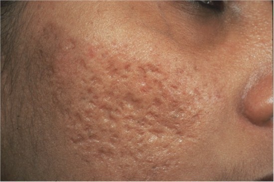what-is-the-treatment-for-acne-scars what is the treatment for acne scars 550x366 What is the Treatment for Acne Scars?